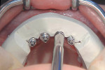 Figure 16 Implants were aligned for rotation intraorally according to an index that was fabricated on the master cast, where the temporary restorations were fabricated.