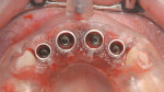 Figure 15 Implants in situ after removal of the insertion assembly.