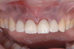 Figure 18 Provisional restorations were placed, replacing four anterior teeth with four implants. To increase stability, the temporary restorations were splinted together intramurally, free of contacts in centric occlusion.