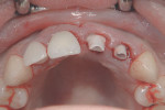 Figure 17 The zirconia abutments were secured intraorally to the implants, and temporary restorations inserted.