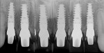 Figure 19 Post-insertion radiographs demonstrated perfect alignment of the implants, with adequate coronal-apical depth and inter-implant distance.