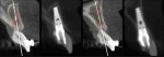 Figure 21 Post-insertion CBCT scans of implant locations, which coincide well with virtual planning on all four sites.