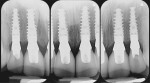 Figure 23 2-year post-insertion radiograph showed minor remodeling between osseous peaks between the central and lateral incisors. The remodeled osseous crest remained above the abutment–implant interfaces.