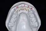 Figure 22 Occlusal view of master cast of final single-tooth restorations showed accurately placed access holes for the screw-retained restorations.
