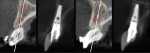 Figure 20 Post-insertion CBCT scans of implant locations, which coincide well with virtual planning on all four sites.