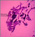 Figure 3 Biopsy of a socket grafted with NanoGen: Histological slide showing newly formed trabecular bone and soft tissue and bone graft remnants (arrow) with abundance of osteoblasts and osteocytes.