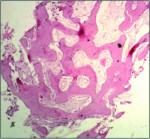 Figure 4 Biopsy of a socket grafted with DentoGen: Histological slide showing newly formed trabecular bone and soft tissue with abundance of osteoblasts and osteocytes.
