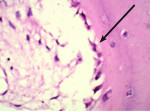 Figure 5 Biopsy report for DentoGen with H & E stain at 40X: The newly formed bone is pink in color. Arrow shows lining osteoblasts with purple nucleus.