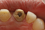 Figure 1 The patient presented with a failed metal post but with adequate remaining structure to save this tooth.