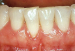 Figure 5a  Preoperative photo of tooth No. 25, which demonstrates approximately 2 mm of gingival recession.