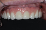 Figure 7 Intraoral and fully retracted views of prosthesis, its contours, and its relationship with the tissues.