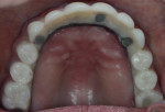 Figure 6 Intraoral and fully retracted views of prosthesis, its contours, and its relationship with the tissues.