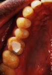 Figure 1 Following endodontic treatment, tooth No. 3 ready for restoration; a provisional restoration is present at the endodontic access.