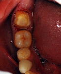 Figure 4 Tooth No. 31 following re-preparation to move margins apically and increase retention by paralleling the preparation walls.