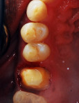 Figure 3 Tooth No. 3 following placement of bonded fiber posts and resin core and crown preparation.