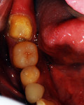 Figure 2 Tooth No. 31 as patient presented with complaint of continual loose crown, which was related to a short preparation with over-tapered walls.