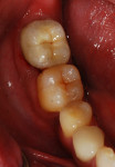 Figure 8 Occlusal view of the luted porcelain-fused-to-metal crown on tooth No. 31, replicating form and esthetics of a natural second mandibular molar.