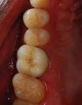 Figure 7 Occlusal view of the luted all-ceramic crown on tooth No. 3, replicating form and esthetics of a natural first maxillary molar.