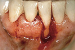 Figure 5b  The donor tissue around tooth No. 26 is ideal laterally to correct the defect.
