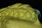Figure 5 Maxillary impression taken in full-arch tray using a two-stage impression technique, with heavy body as the tray material and relined with extra-light body impression material.