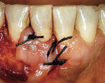 Figure 5c  After rotation and suturing of the flap, the root on tooth No. 25 is entirely covered with keratinized gingiva.