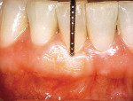 Figure 5d  After 1 year, the postoperative photo reveals complete coverage of the root. Note that the donor site has no recession.