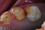Figure 2 Enamel malformation and beginning caries seen on maxillary primary molars.