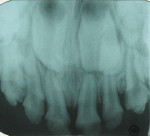 Figure 4 Preoperative maxillary radiograph.