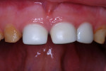 Figure 7 Central incisors 1 year postoperatively; zirconia crown on lateral incisor 3 months after treatment.