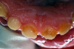 Figure 3 Lingual caries lesions of maxillary central incisors.