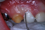Figure 13 Crown seated with finger pressure; excess luting cement removed.