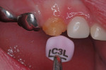 Figure 15 Pink canine ''try-in'' crown for sizing.