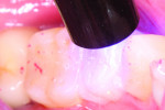 Figure 4 Resin cement of seated provisional was light cured.