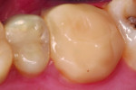 Figure 1 Provisional restoration that was worn for 2 years by a patient.
