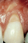 Figure 7a  A preoperative photograph of a 5- mm gingival recession. Note the abrasion of the tooth structure on the root surface.