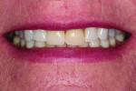 Figure 15 Patient presented with crowns that did not match the rest of the dentition after whitening.