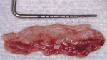 Figure 7b  A connective tissue graft taken from the palate. Note the margin of epithelium at the edge of the graft nearest the periodontal probe. The average thickness is 0.6 mm.