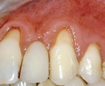 Figure 8a  Preoperative photograph demonstrates significant gingival recession on teeth Nos. 9 and 11. An acellular dermal matrix allograft will be used to correct the problem.
