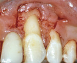 Figure 8b  Reflection of the flap reveals bone loss on the facial surface of tooth No. 11.