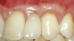 Figure 8c  The 2-year postoperative photograph shows attached keratinized gingiva covering the root surface.