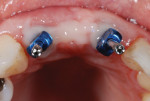 Fig 7. The material should be used to cover all gingiva that was shaped by the provisional restoration.