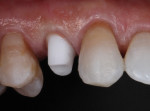 Fig 10. A properly designed abutment will maintain the developed architecture of the gingiva by maintaining the proven emergence of the provisional restoration.