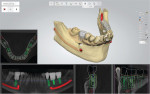 Fig 1. 3Shape's Implant Studio showing simultaneous views of the restorative design, surface scan, nerve location, proposed implant placement, and bone-density information.
