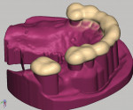 Fig 11. Toothborne portion of the guide.