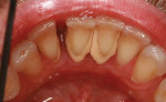 Fig 1 and Fig 2. Severe calculus buildups and extremely poor hygiene, with 4 lower incisors needing to be extracted.