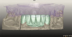 Fig 5 and Fig 6. During the CAD phase, the author reduced 1 mm of the vertical incisal length and 0.5 mm from the labial to provide room for layering ceramics.