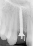 Figure 15  The digital periapical radiograph of the completed case.