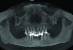 Panoramic view rendered from a cone-beam computed tomography (CBCT) scan taken to plan placement of implants.