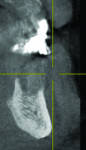 CBCT cross-section (sagittal) view through the osseous defect in the mandible demonstrating loss of the buccal and lingual plates and height of the ridge in this region.