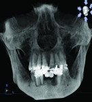 CBCT scan confirming osseous defect and associated failing dentition.